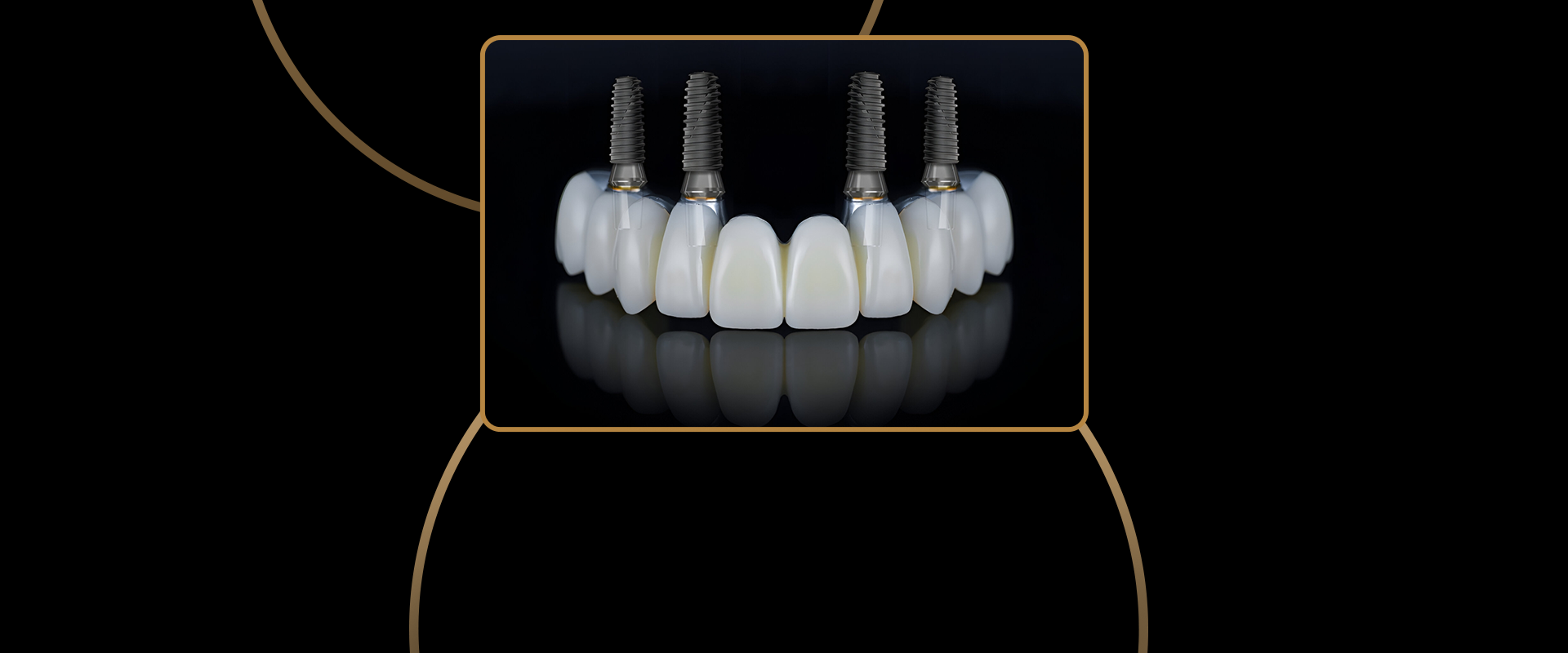 All-on-4 Dental Implants